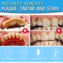 TOOTH STAIN ERASER